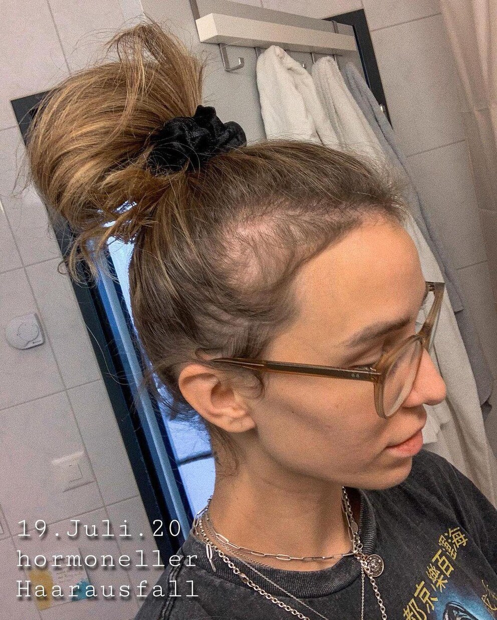 Die Schweizer Influencerin Anja Zeidler zeigte ein halbes Jahr nach der Geburt ihrer Tochter ihren Haarausfall und nachwachsenden Härchen.