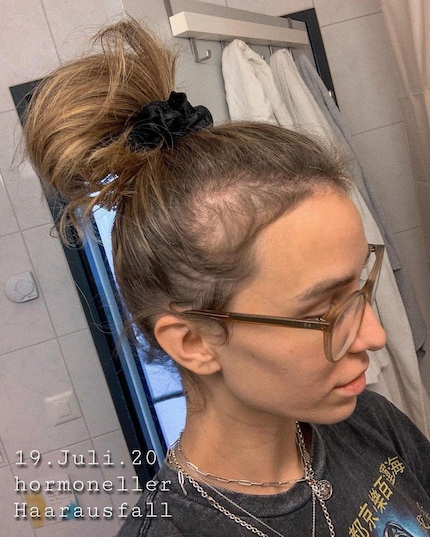 Swiss influencer Anja Zeidler showed off her hair loss and newly regrown hair six months after the birth of her daughter.