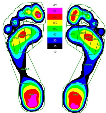 Professional pedobarography: I have a higher peak in pressure on my left big toe. The insole there is also much more worn down than on the right.