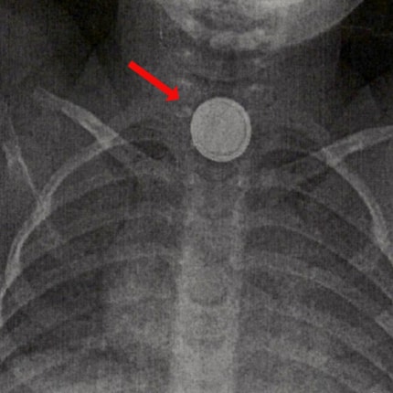 A life-threatening emergency: X-ray image of a button battery in the oesophagus of a small child.
